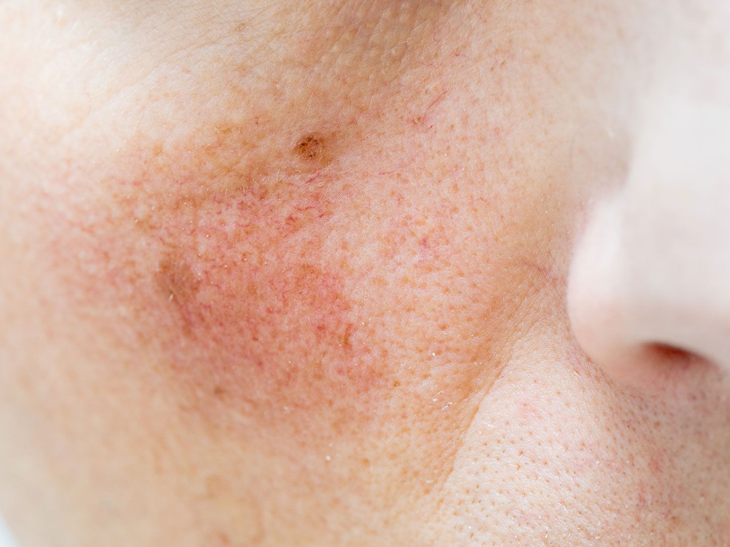 What is rosacea? A dermatologist's guide to symptoms and treatments